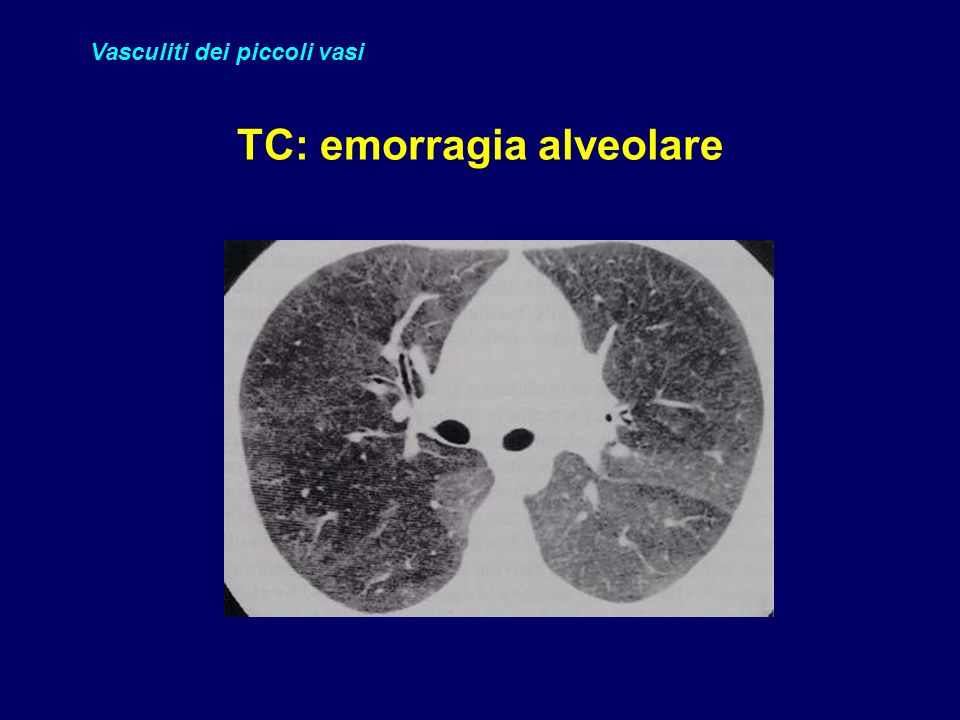 TC: emorragia alveolare