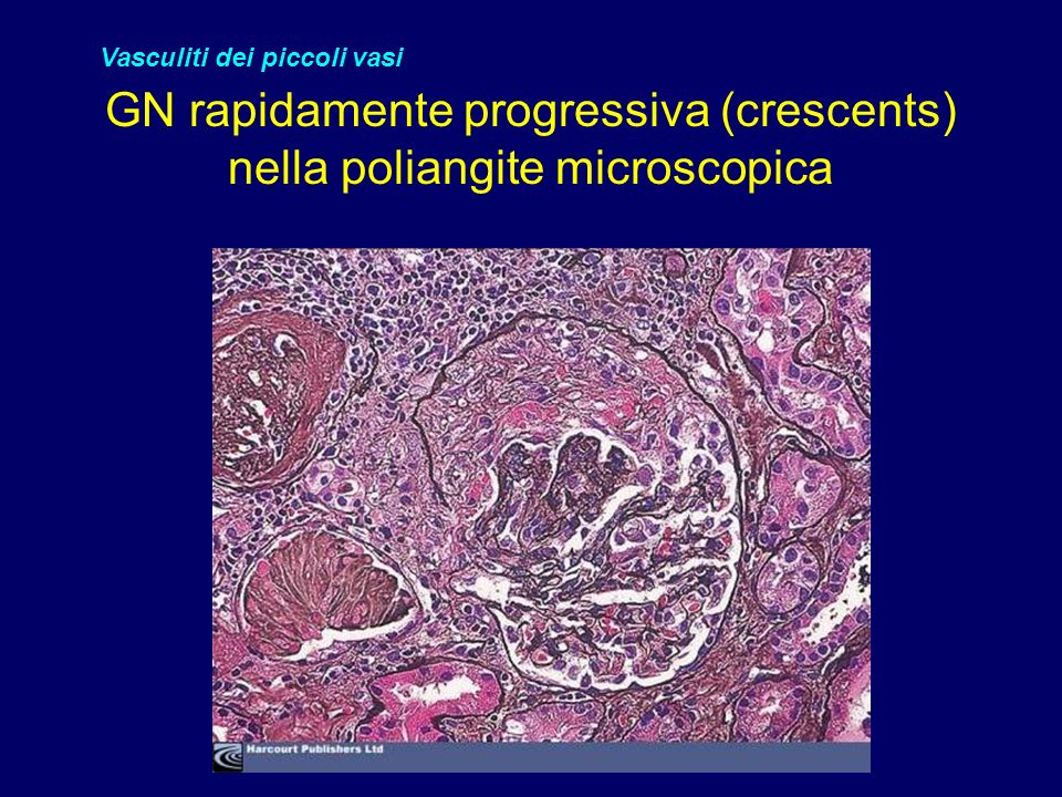 GN rapidamente progressiva (crescents) nella poliangite microscopica