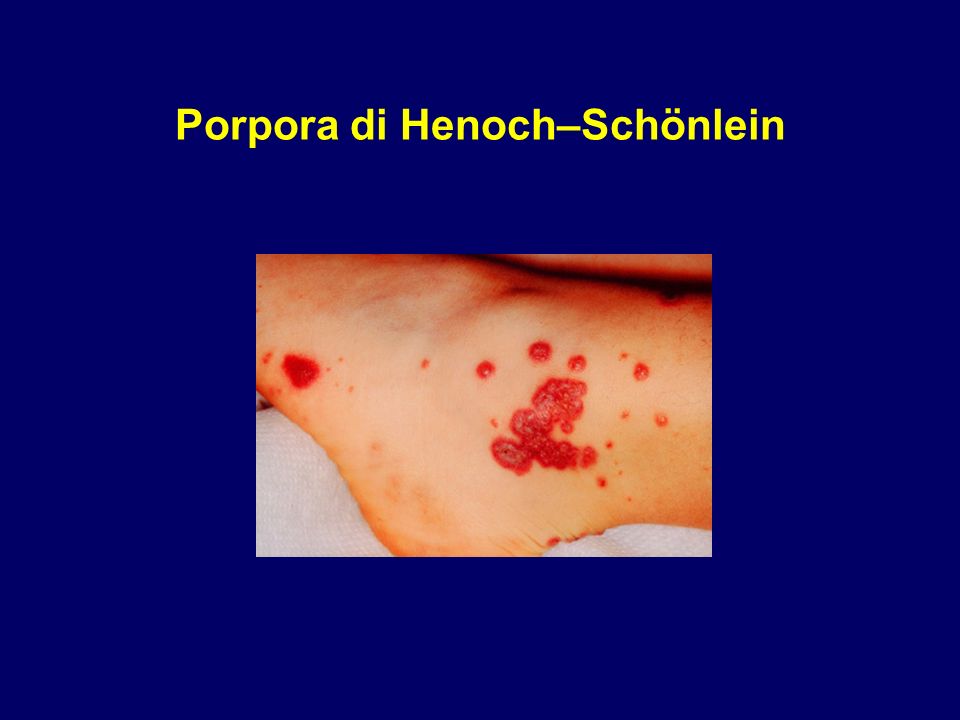 Porpora di Henoch–Schönlein