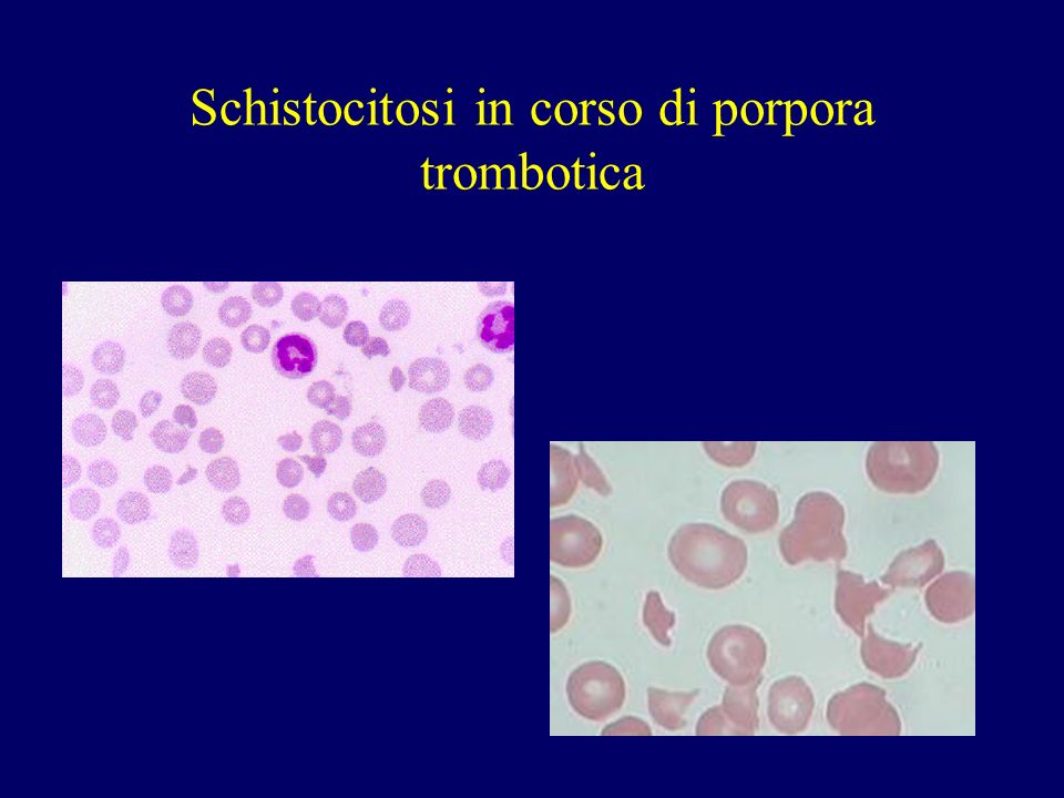 Schistocitosi in corso di porpora trombotica