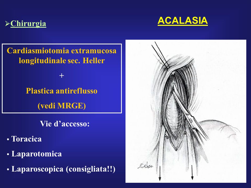 ACALASIA Chirurgia. Cardiasmiotomia extramucosa longitudinale sec. Heller. + Plastica antireflusso.