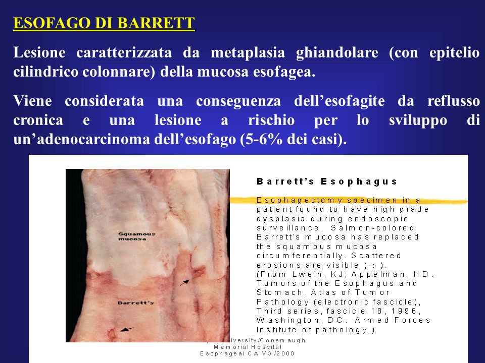 ESOFAGO DI BARRETT Lesione caratterizzata da metaplasia ghiandolare (con epitelio cilindrico colonnare) della mucosa esofagea.