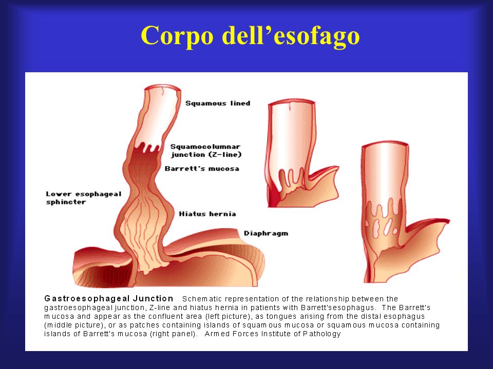 Corpo dell’esofago