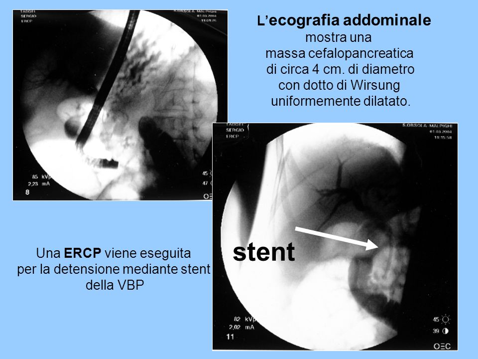 stent L’ecografia addominale mostra una massa cefalopancreatica