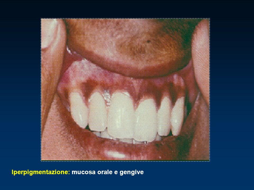 Iperpigmentazione: mucosa orale e gengive