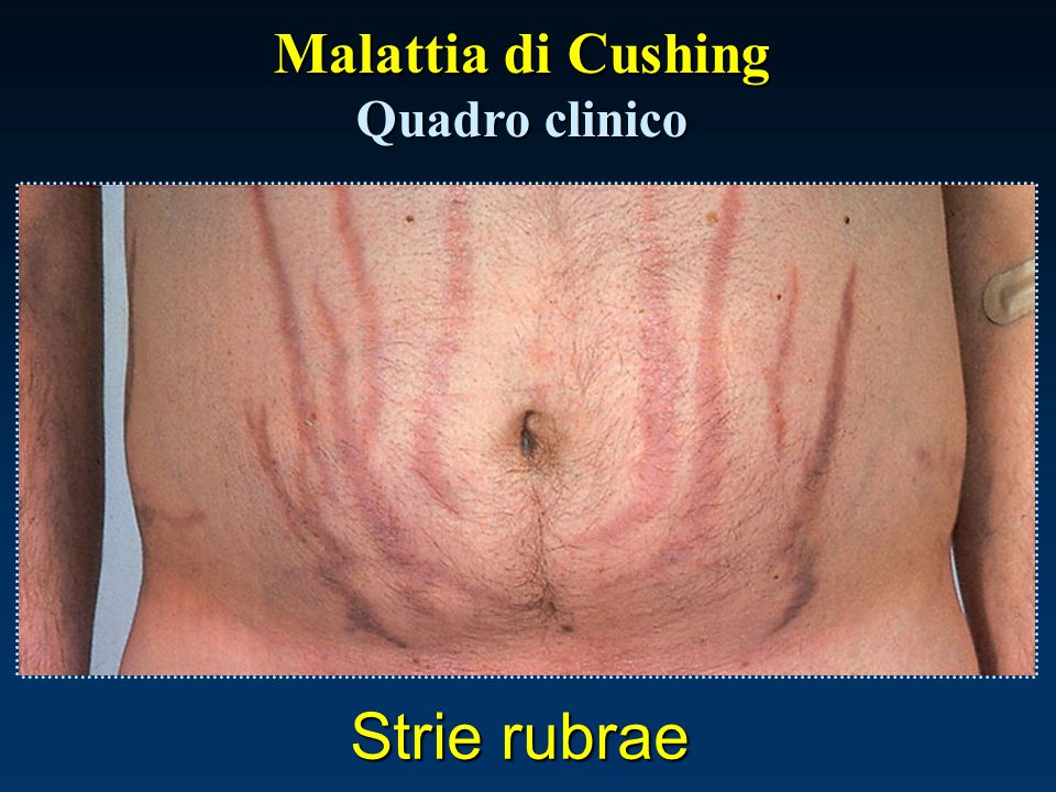 Malattia di Cushing Quadro clinico