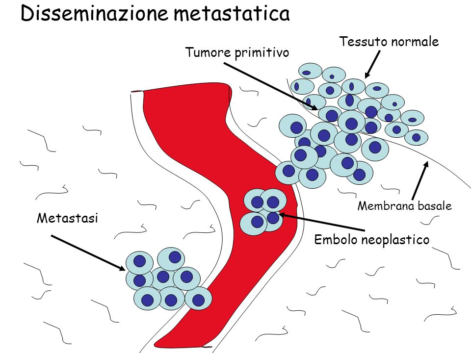 Disseminazione metastatica