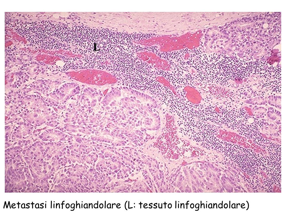 L Metastasi linfoghiandolare (L: tessuto linfoghiandolare)