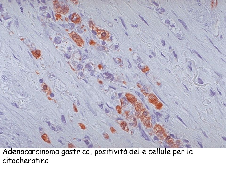Adenocarcinoma gastrico, positività delle cellule per la