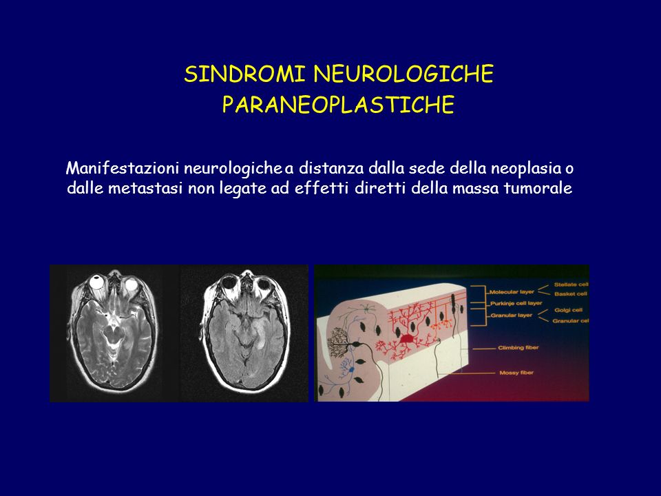 SINDROMI NEUROLOGICHE PARANEOPLASTICHE