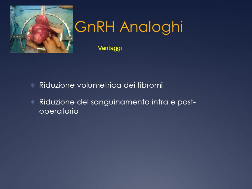 GnRH Analoghi Riduzione volumetrica dei fibromi