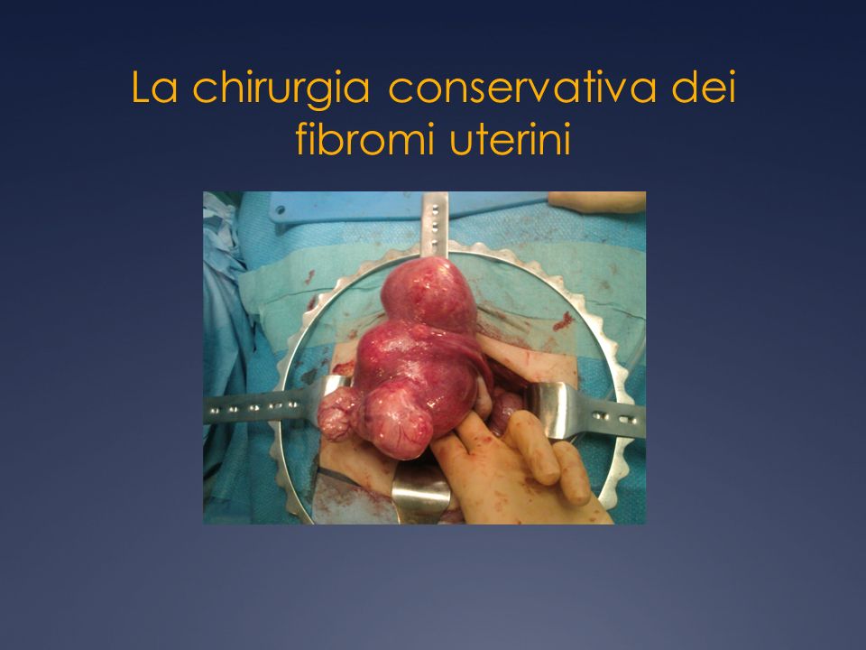 La chirurgia conservativa dei fibromi uterini