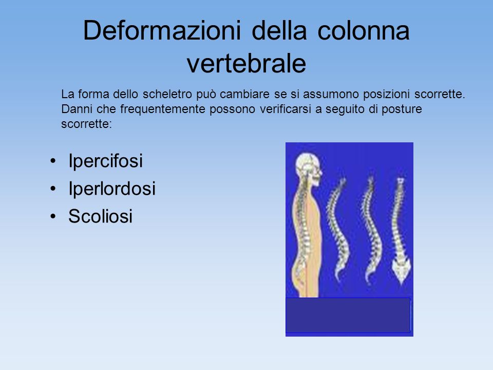 Deformazioni della colonna vertebrale