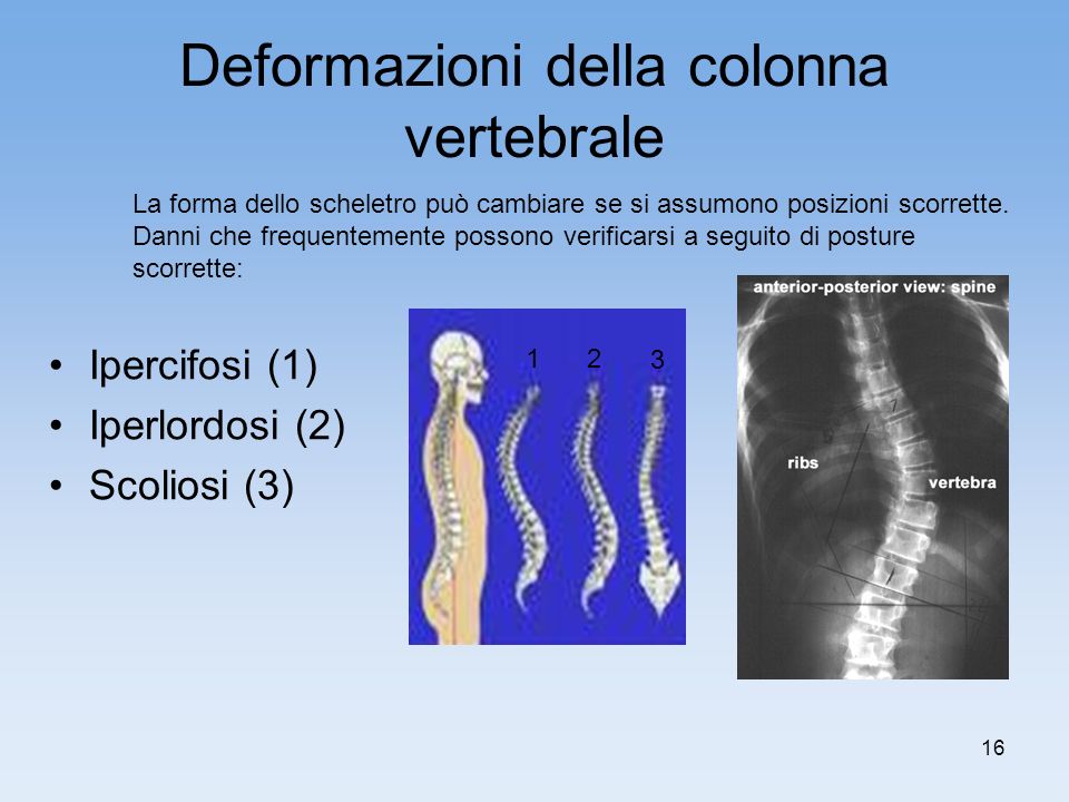 Deformazioni della colonna vertebrale