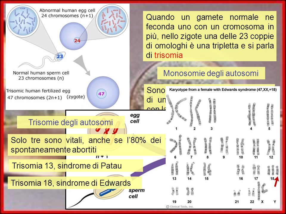 Monosomie degli autosomi