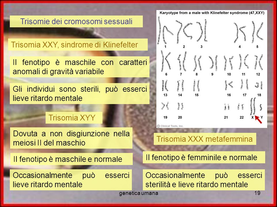 Trisomie dei cromosomi sessuali