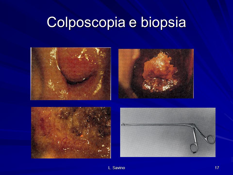 Colposcopia e biopsia L. Savino