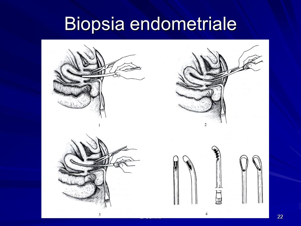 Biopsia endometriale L. Savino