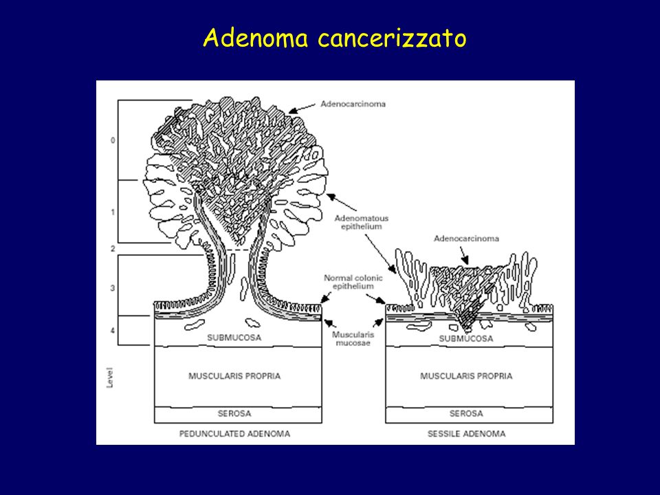 Adenoma cancerizzato