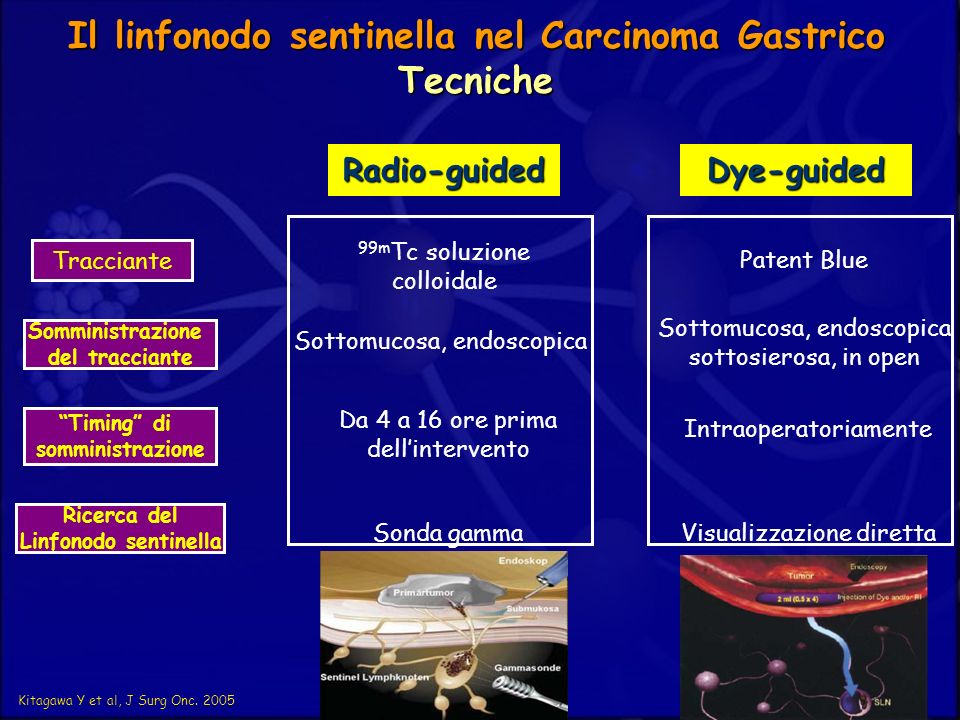 Il linfonodo sentinella nel Carcinoma Gastrico Tecniche