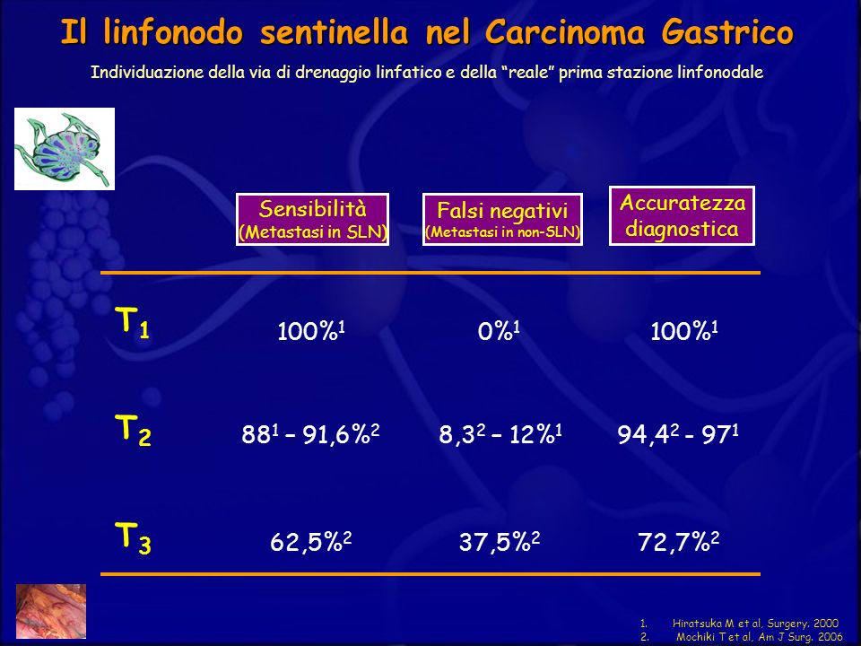 Il linfonodo sentinella nel Carcinoma Gastrico