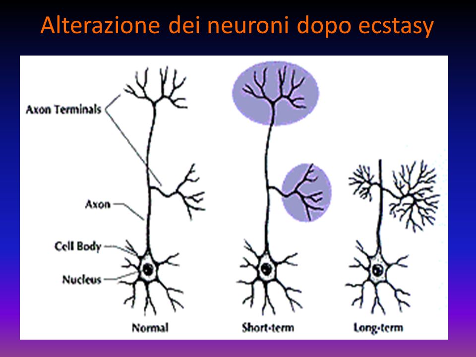 Alterazione dei neuroni dopo ecstasy