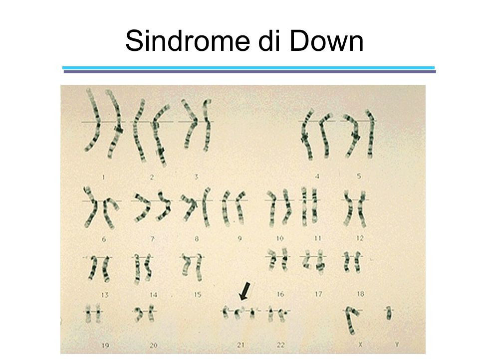 Sindrome di Down