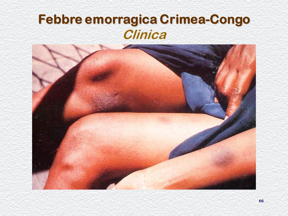 Febbre emorragica Crimea-Congo Clinica