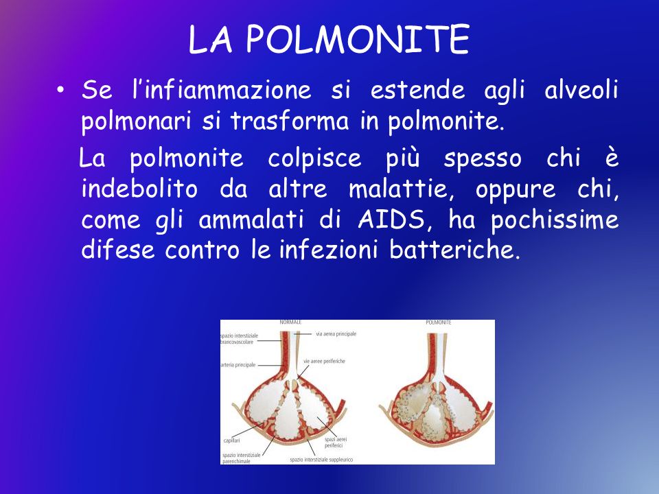 LA POLMONITE Se l’infiammazione si estende agli alveoli polmonari si trasforma in polmonite.