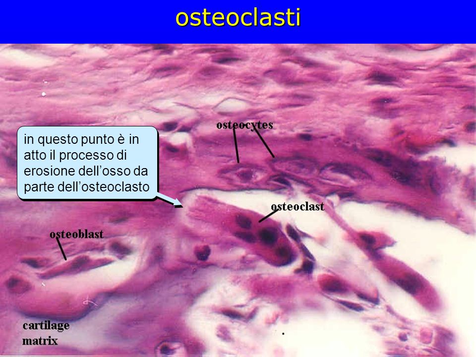 osteoclasti in questo punto è in atto il processo di erosione dell’osso da parte dell’osteoclasto