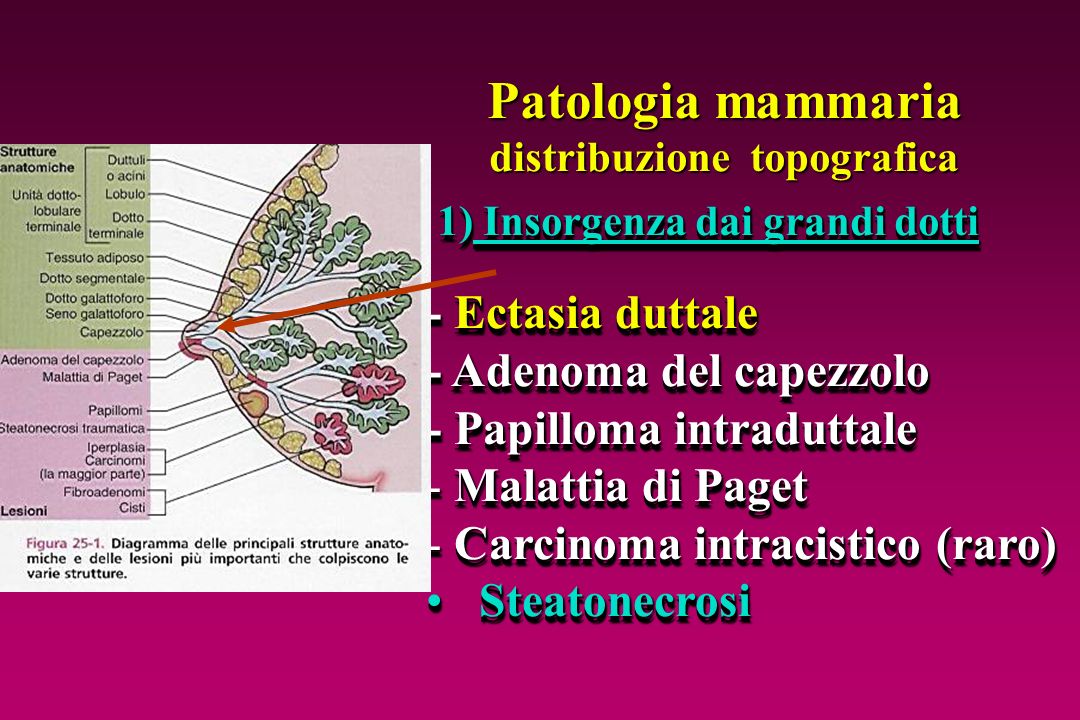 papilloma intraduttale della mammella papilloma virus uomo esame