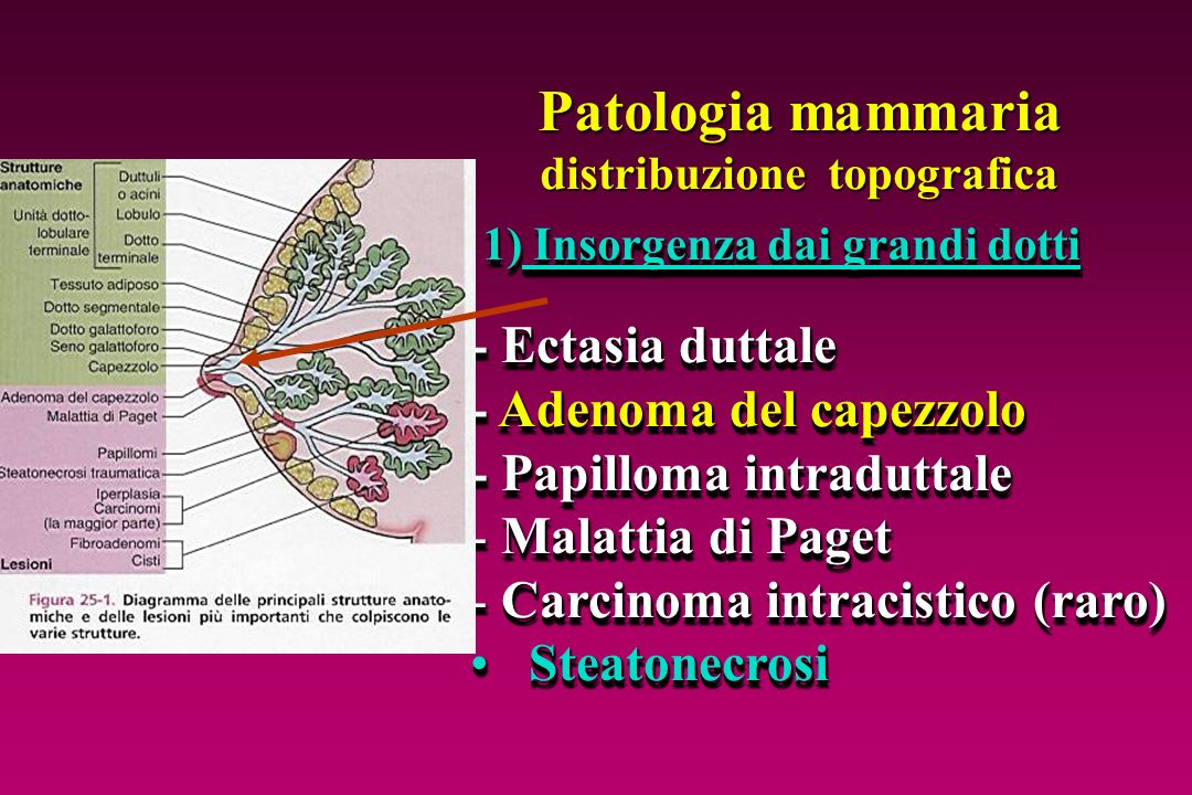 Papilloma intraduttale c3. Intraduktal papilloma tedavisi