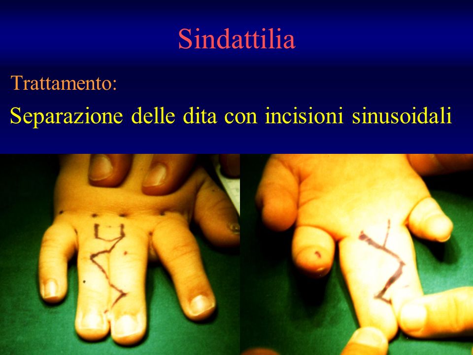 Trattamento: Separazione delle dita con incisioni sinusoidali