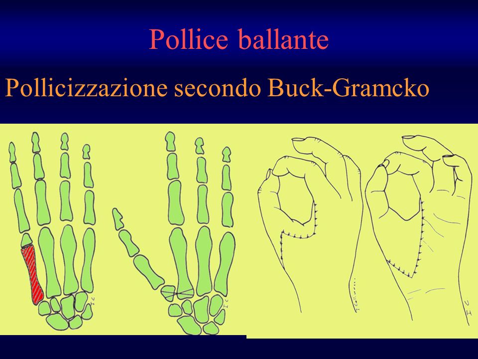 Pollicizzazione secondo Buck-Gramcko