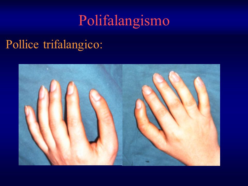 Pollice trifalangico: