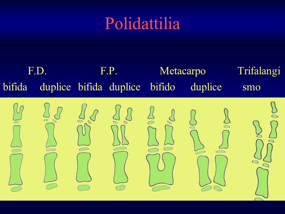 Polidattilia F.D. F.P. Metacarpo Trifalangi
