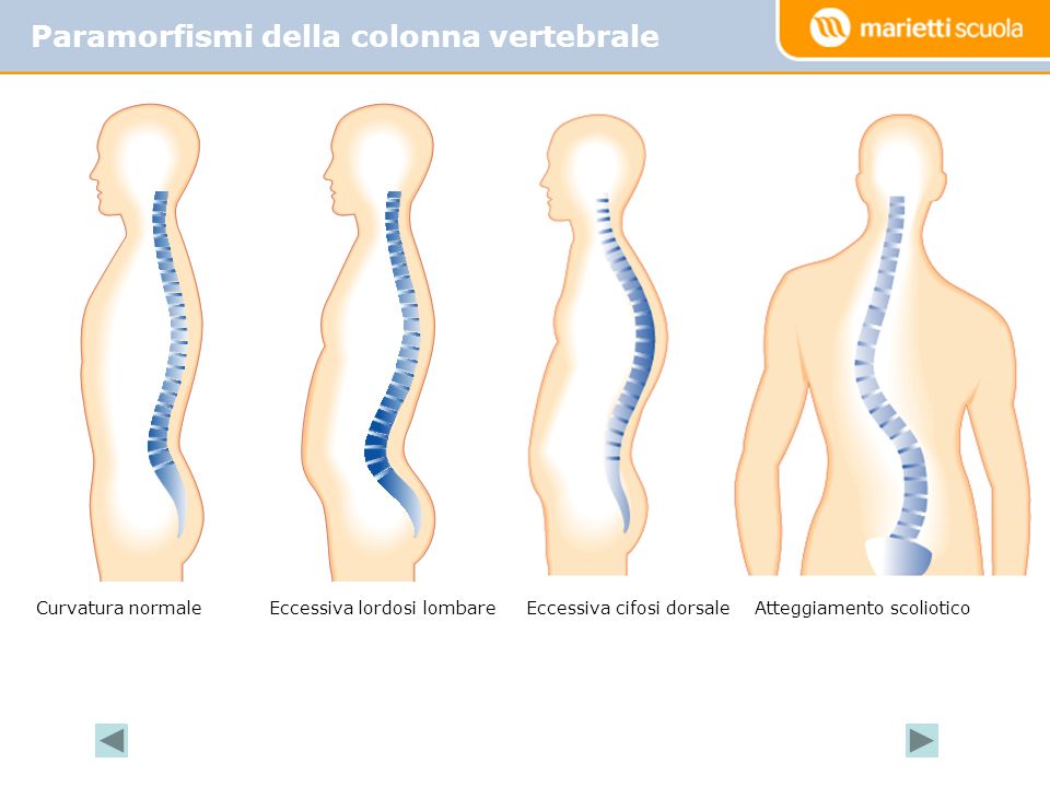 Paramorfismi della colonna vertebrale