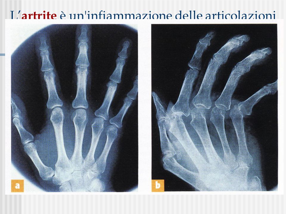 L’artrite è un infiammazione delle articolazioni che si manifesta con dolore e gonfiore; se non curata, può provocare la degenerazione delle cartilagini articolari
