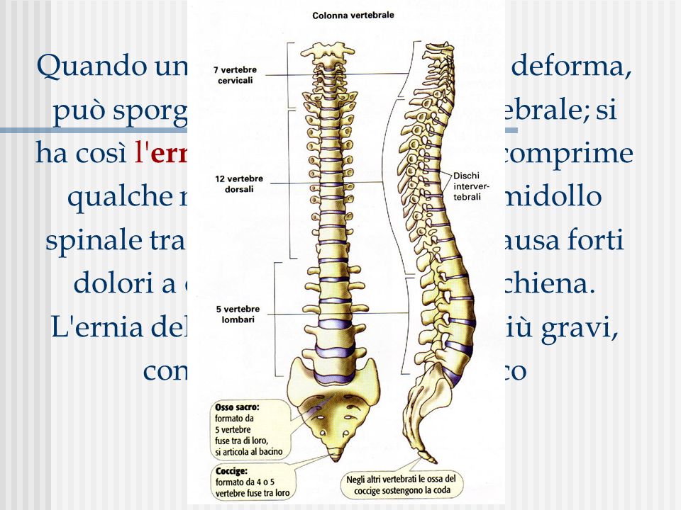 Quando un disco intervertebrale si deforma, può sporgere fuori dal corpo vertebrale; si ha così l ernia del disco.