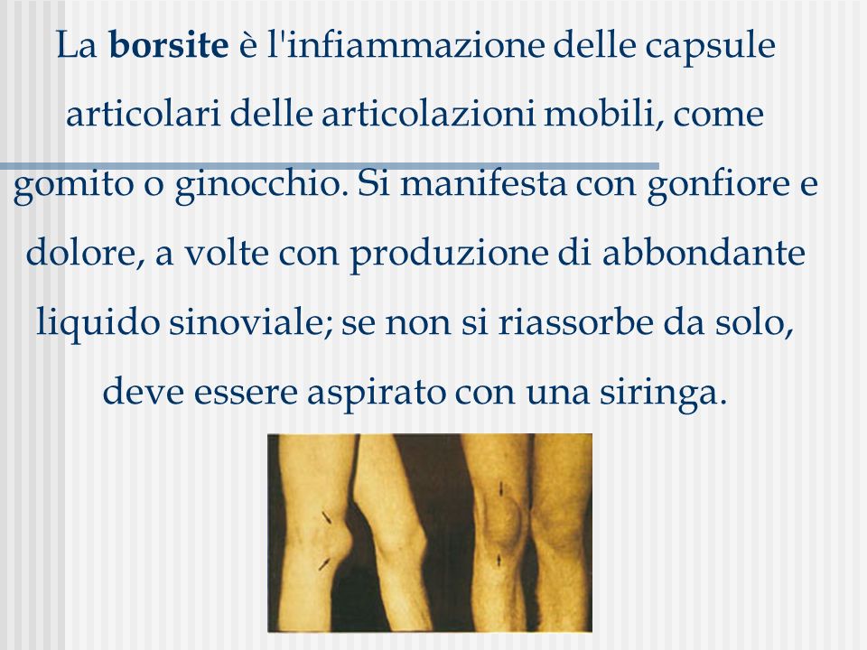 La borsite è l infiammazione delle capsule articolari delle articolazioni mobili, come gomito o ginocchio.